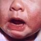 Baby with eczema